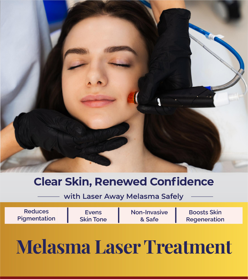Melasma Laser Treatment