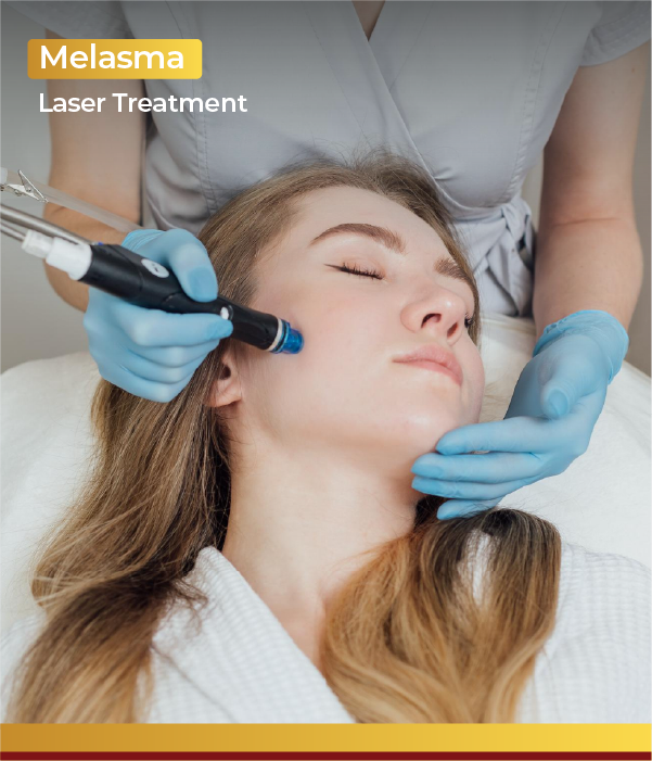 Melasma Laser Treatment