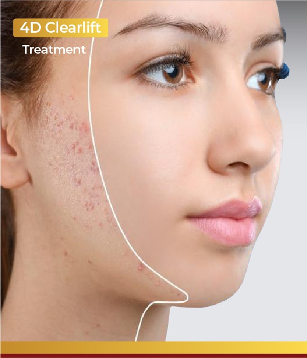 4D clearLift therapy